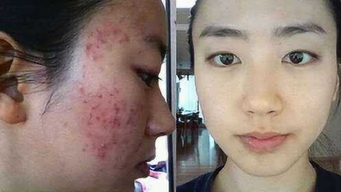 如何有效去除痘痘,方法与策略探讨,探讨有效去除痘痘的方法与策略