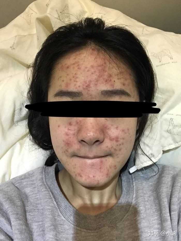 如何有效去除痘痘,方法与策略探讨,探讨有效去除痘痘的方法与策略